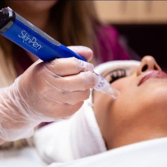 SkinPen Signature Series(Face+Neck) at BLUSH Aesthetics LLC in Laredo, TX